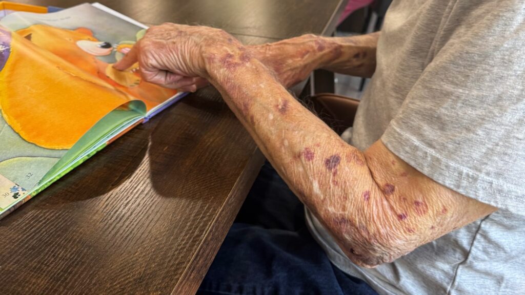 Are Those Skin Spots Worth Treating? What New Jersey Families Should Know About Actinic Keratoses